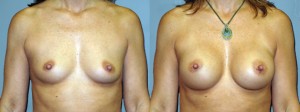 Breast-Augmentation-Round-Silicone-Gel-286cc