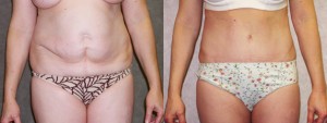 dr-dembny-tummy-tuck-163-AP