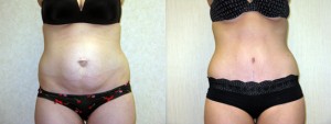 dr-dembny-abdominoplasty-164-AP