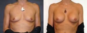 drdembny-191-breast-augmentation-saline-AP