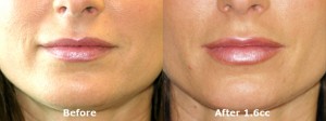 dr-dembny-juvederm-lip-enhancement-215-AP