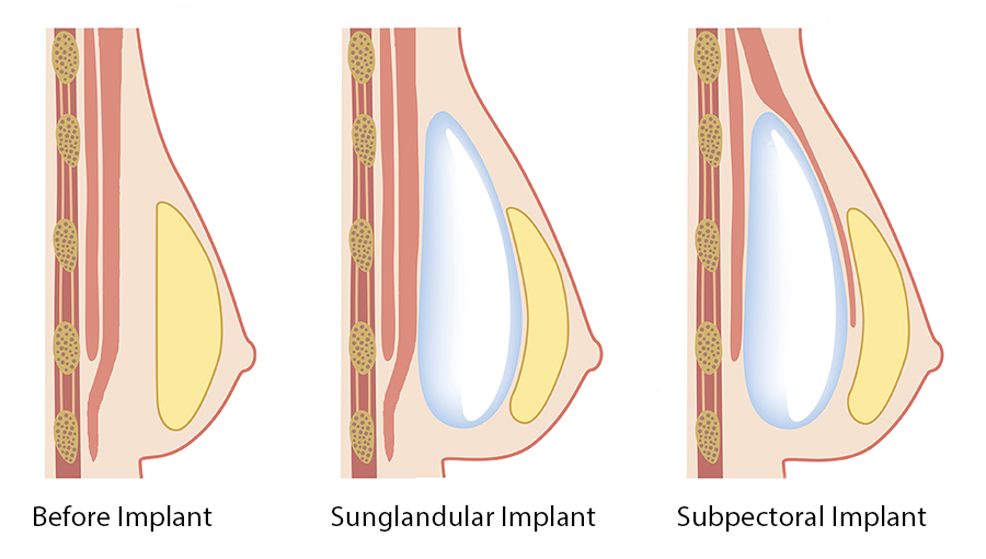 Subglandular-&-Submuscular-Breast-Augmentation-Illustration-Dr-Dembny