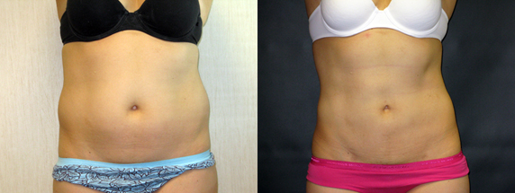 Before-&_After_liposuction-Result-Dr-Dembny