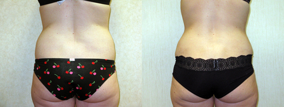 dr-dembny-Abdominoplasty-tummy-tuck-patient-164-Back