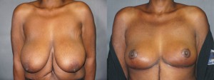 Image of Breast Reduction