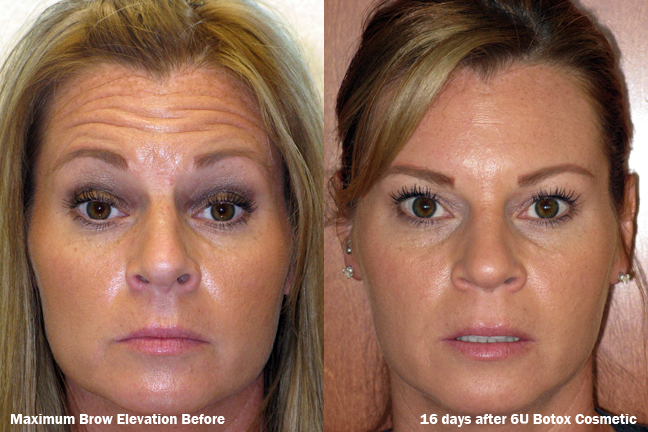 dr-dembny-6U-Botox-Cosmetic-Forehead-Lines-patient-360