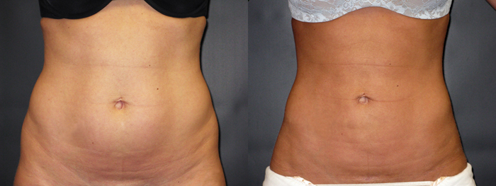 Liposuction of Flanks Before and After 3804