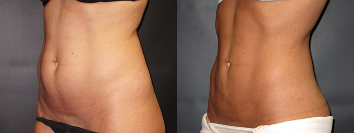 dr-dembny-liposuction-abdomen-flank-patient-29-LOblq