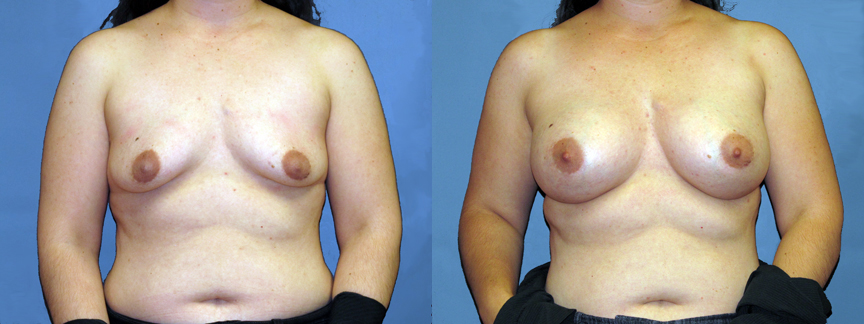 dr-dembny-breast-augmentation-silicone-gel-patient-668-AP