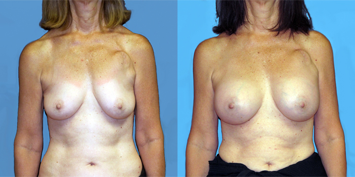 dr-dembny-breast-augmentation-silicone gel-patient-777-AP