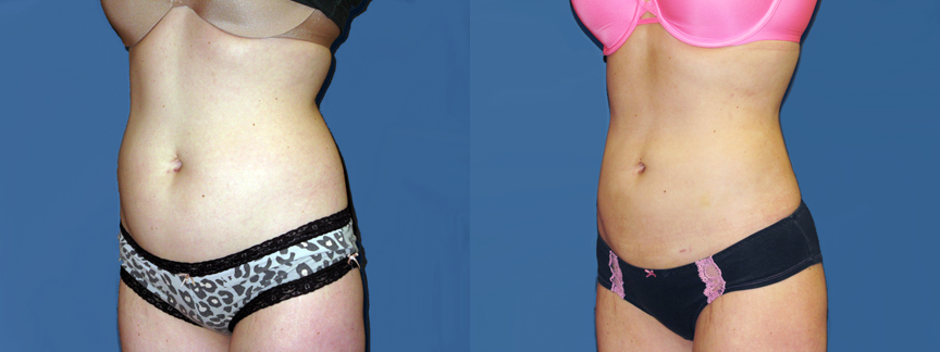 dr-dembny-liposuction-abdomen-flank-patient-599-LOblq