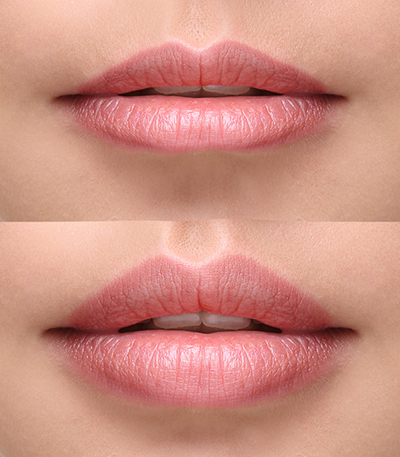 Lip-enhancement-B&A-Dr-Dembny